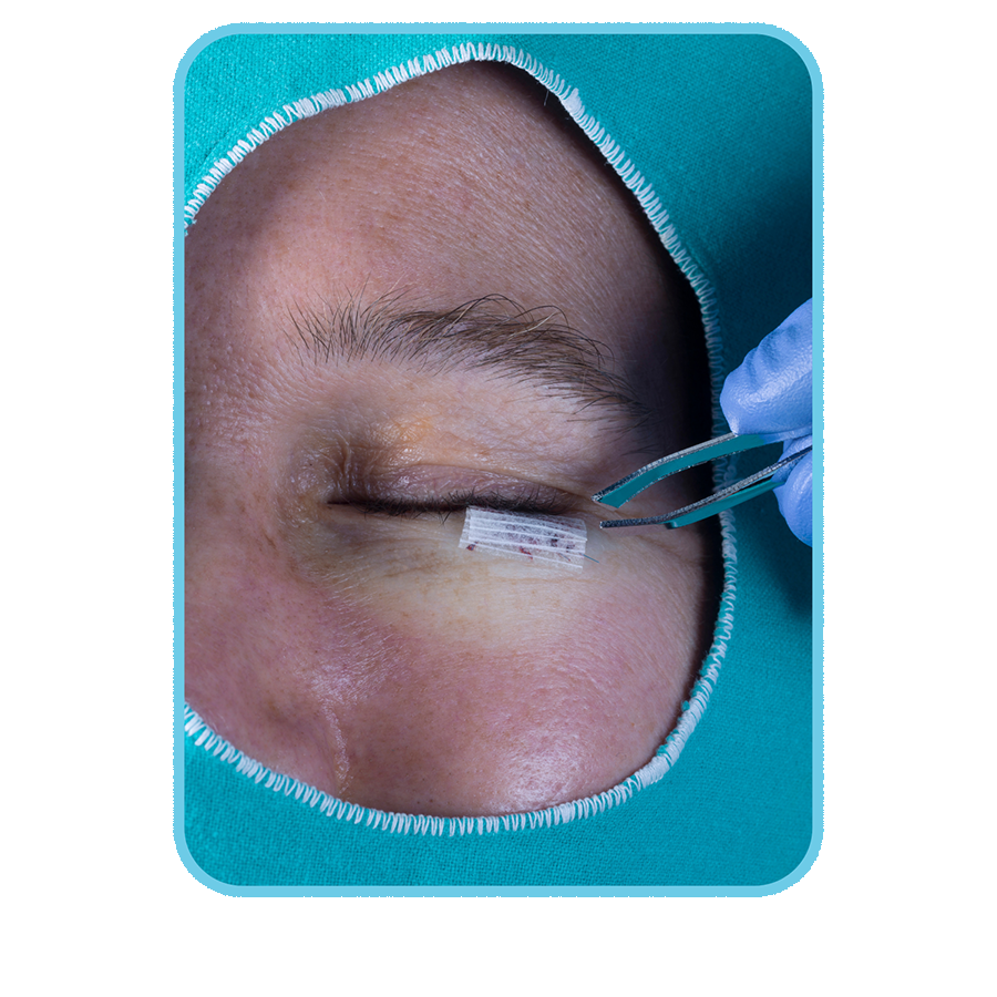 Eyelid Surgery medical planet istanbul